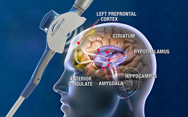 Transcranial Magnetic Stimulation (TMS)